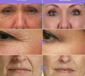 Kolajen serum ne zaman sonuç verir?